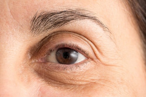Attenuare le occhiaie con 5 rimedi naturali