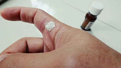 Verruche e farmaci topici.