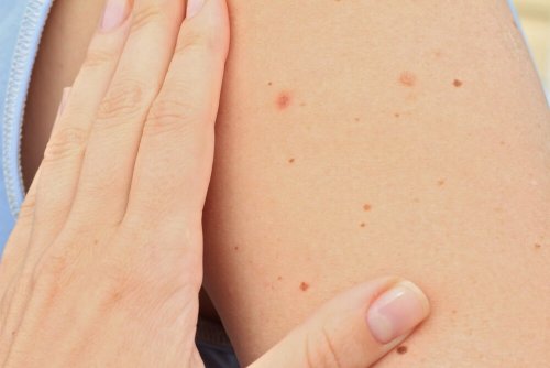 Identificare un neo sospetto