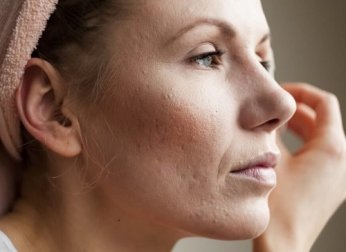 Chiudere i pori dilatati del viso: utili consigli