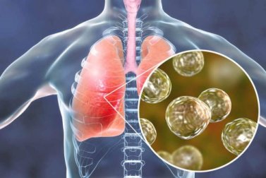 Blastomicosi: calmare i sintomi con rimedi naturali