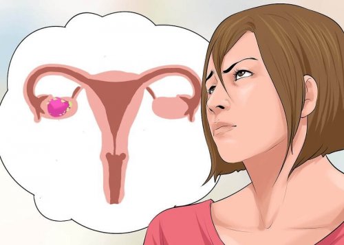 Cancro delle ovaie: effetti collaterali