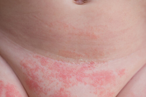 Dermatite da pannolino: consigli per evitarla