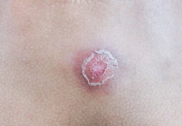 Eliminare i brufoli e prevenire gli ascessi