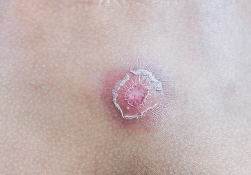 Eliminare i brufoli e prevenire gli ascessi