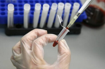 AIDS: forse sconfitto dalle cellule staminali