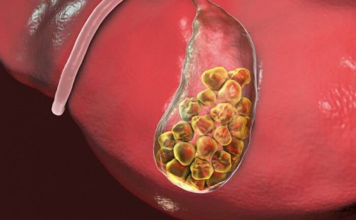 Calcoli nella cistifellea