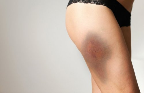 Donna con ematoma sulla coscia sinistra