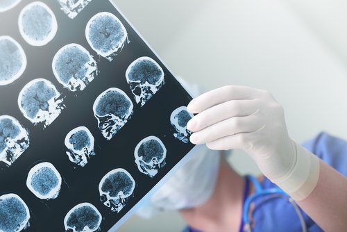 Dottoressa guarda lastra differenza tra demenza senile e Alzheimer
