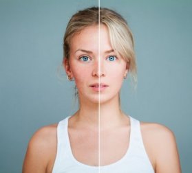 Rosacea e alimentazione per calmare i sintomi