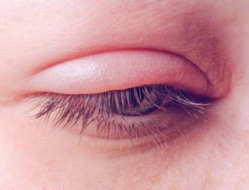 Blefarite Cause Sintomi E Trattamento Vivere Piu Sani