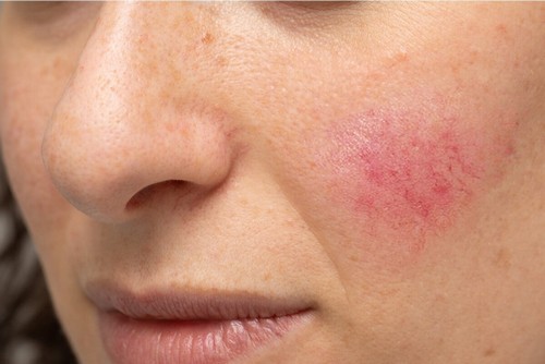 Rosacea sulla pelle del viso.