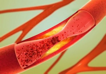 Proteggere le arterie, sane abitudini