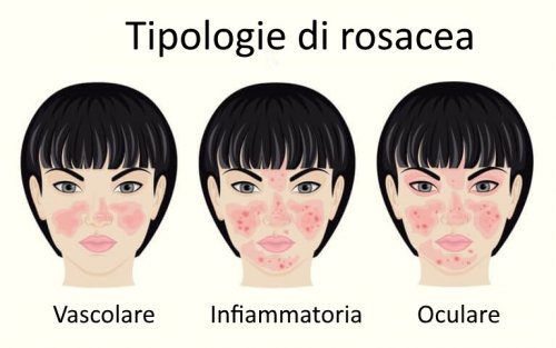 aiuterà la perdita di peso rosacea