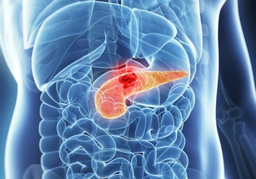 Tumore del pancreas