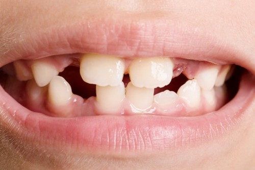 Agenesia dentale: che cos’è e come trattarla