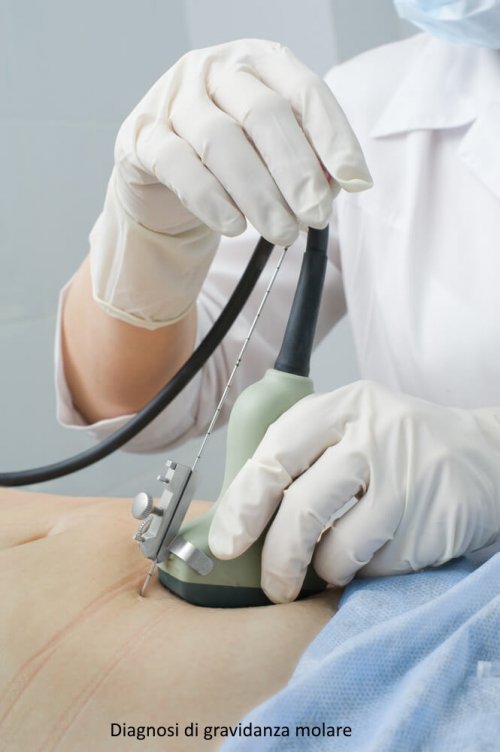 Amniocentesi per una diagnosi