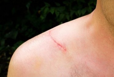 Creme naturali per attenuare le cicatrici