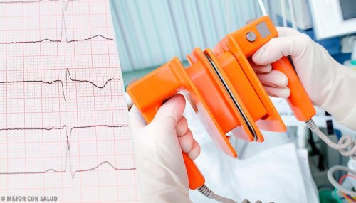 Fibrillazione atriale: defibrillatore.