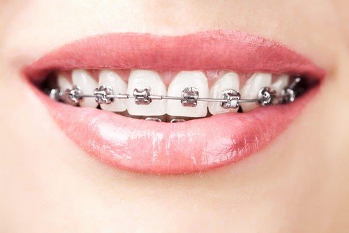 Denti con apparecchio ortodontico fisso