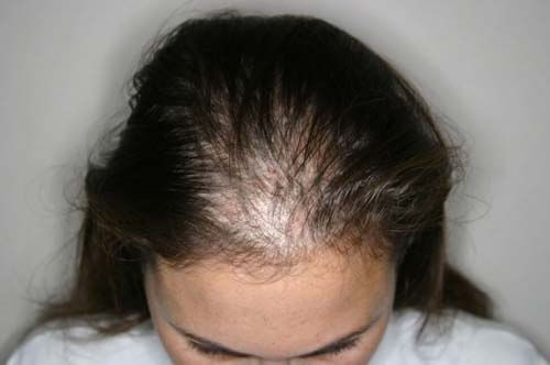 Donna con alopecia