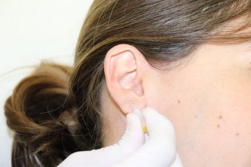 Donna riceve trattamento di auricolopuntura.