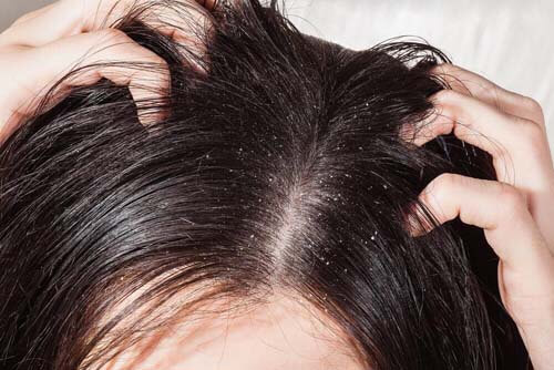 Forfora e motivi per cui cadono i capelli