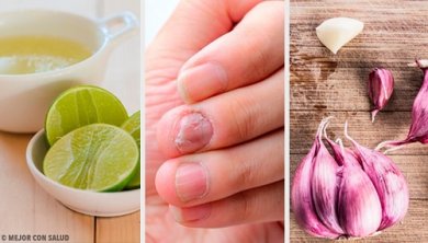 Eliminare la micosi delle unghie con rimedi naturali
