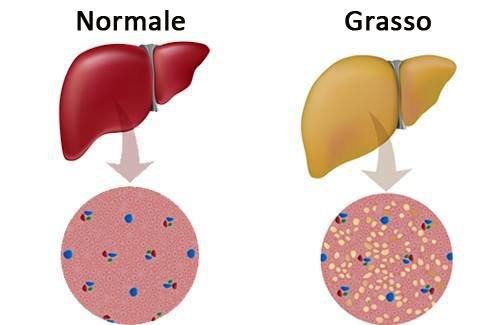 Fegato normale e grasso