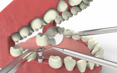 Impianto dentale