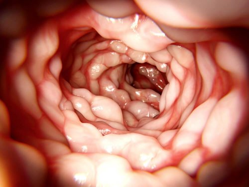 Morbo di crohn presenza di muco nelle feci