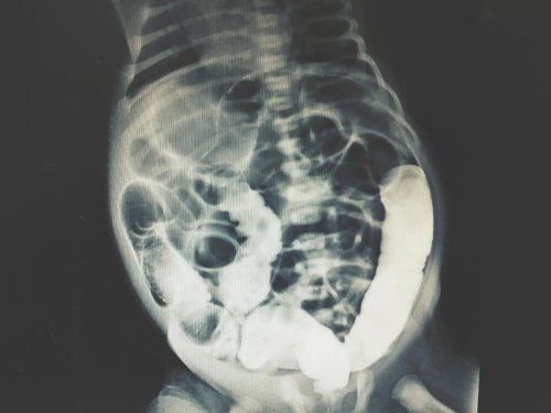 Radiografia peritoneale