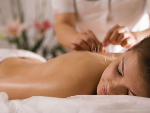 Ragazza si sottopone ad agopuntura