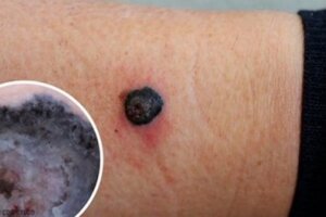 Melanoma maligno