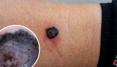 Melanoma maligno