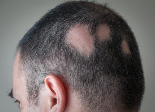 Uomo con alopecia
