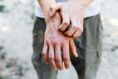 Dermatite da contatto e rimedi naturali