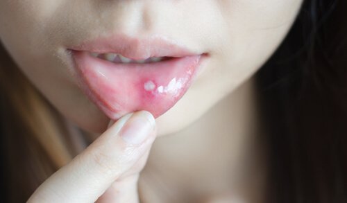 Le afte o piaghe della bocca: come curarle?