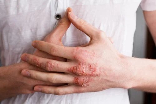 Eczema sulle mani