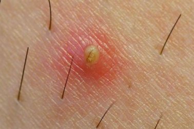 I peli incarniti e come prevenirli con alcuni consigli