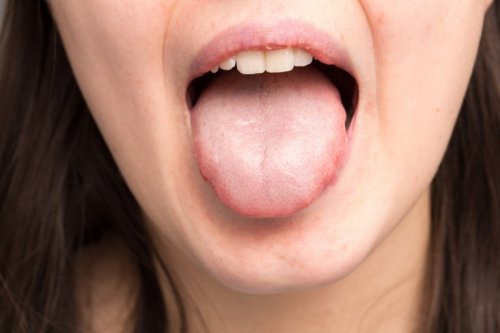 Infezioni del cavo orale