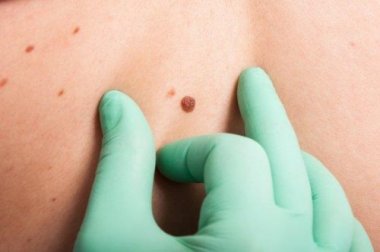 La regola ABCDE in dermatologia