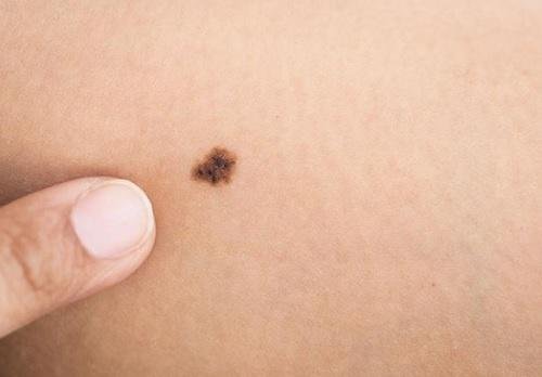 Neo Rugoso La regola ABCDE in dermatologia - Vivere più sani