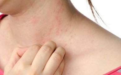 Calmare l'orticaria con 3 rimedi naturali