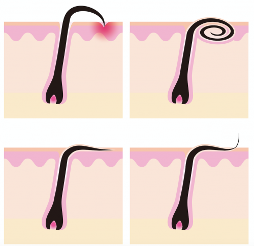 Pelo infiammato