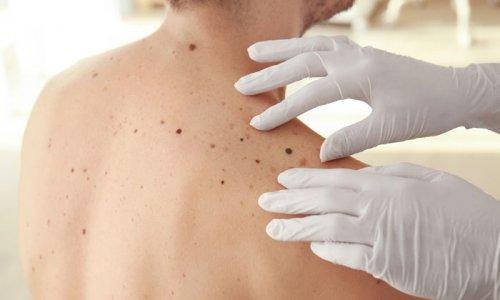 Persona con molti nei