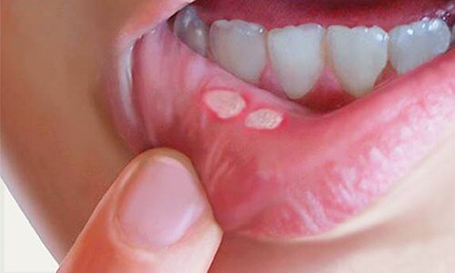 Curare le afte della bocca con rimedi naturali