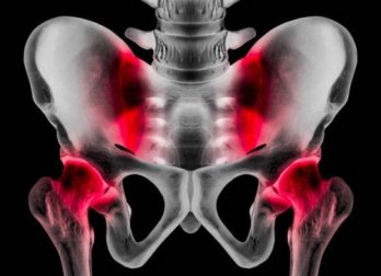 Pubalgia: cause, sintomi e trattamento