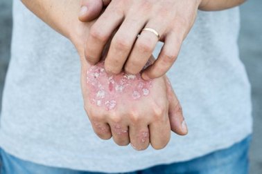Trattamenti topici alle erbe per la psoriasi