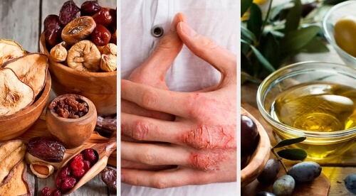 Eczema cutaneo: cause, sintomi e trattamento